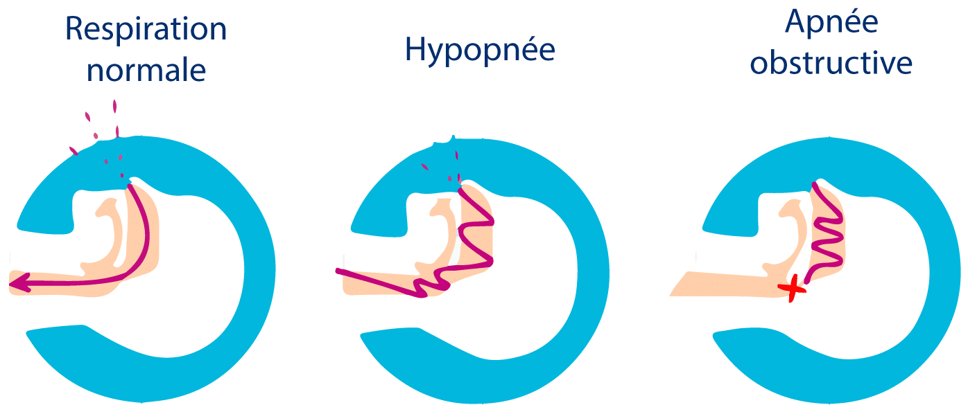 Respiration-apnee-hypopnee_cpap-store.fr-02